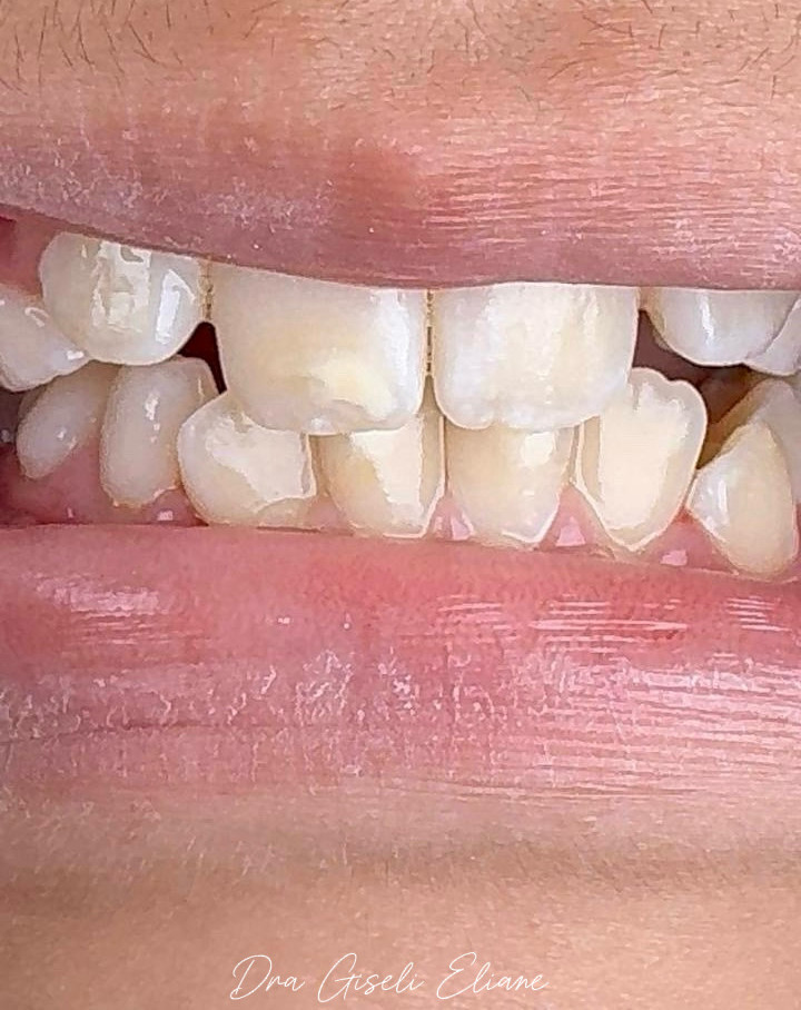 Na dentição mista, dentes de leite e permanentes estão presentes ao mesmo tempo.