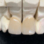 Two central crowns on a model.