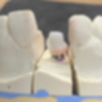 Custom Zirconia Abutment with added pink tissue on a model.
