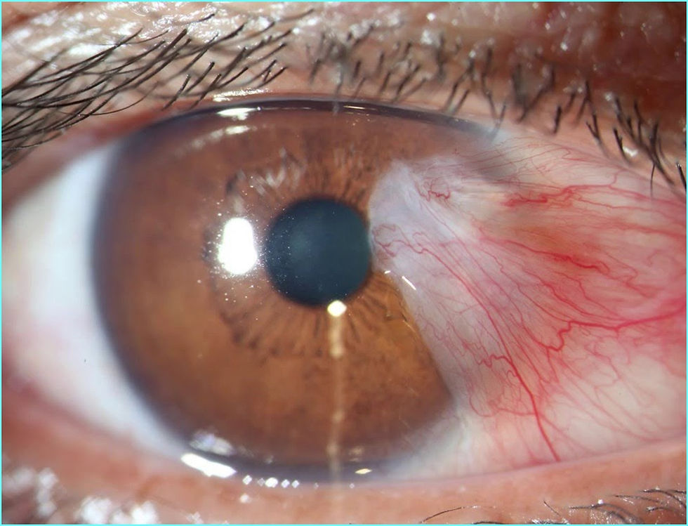 Pterígio volta depois da cirurgia?