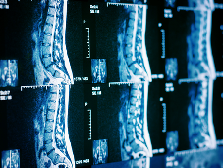A Comprehensive Guide to Spine MRIs: What, Why, and How?