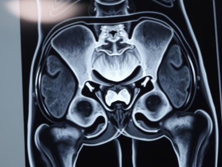 MRI for hip pain: when imaging can help identify labral tears or arthritis