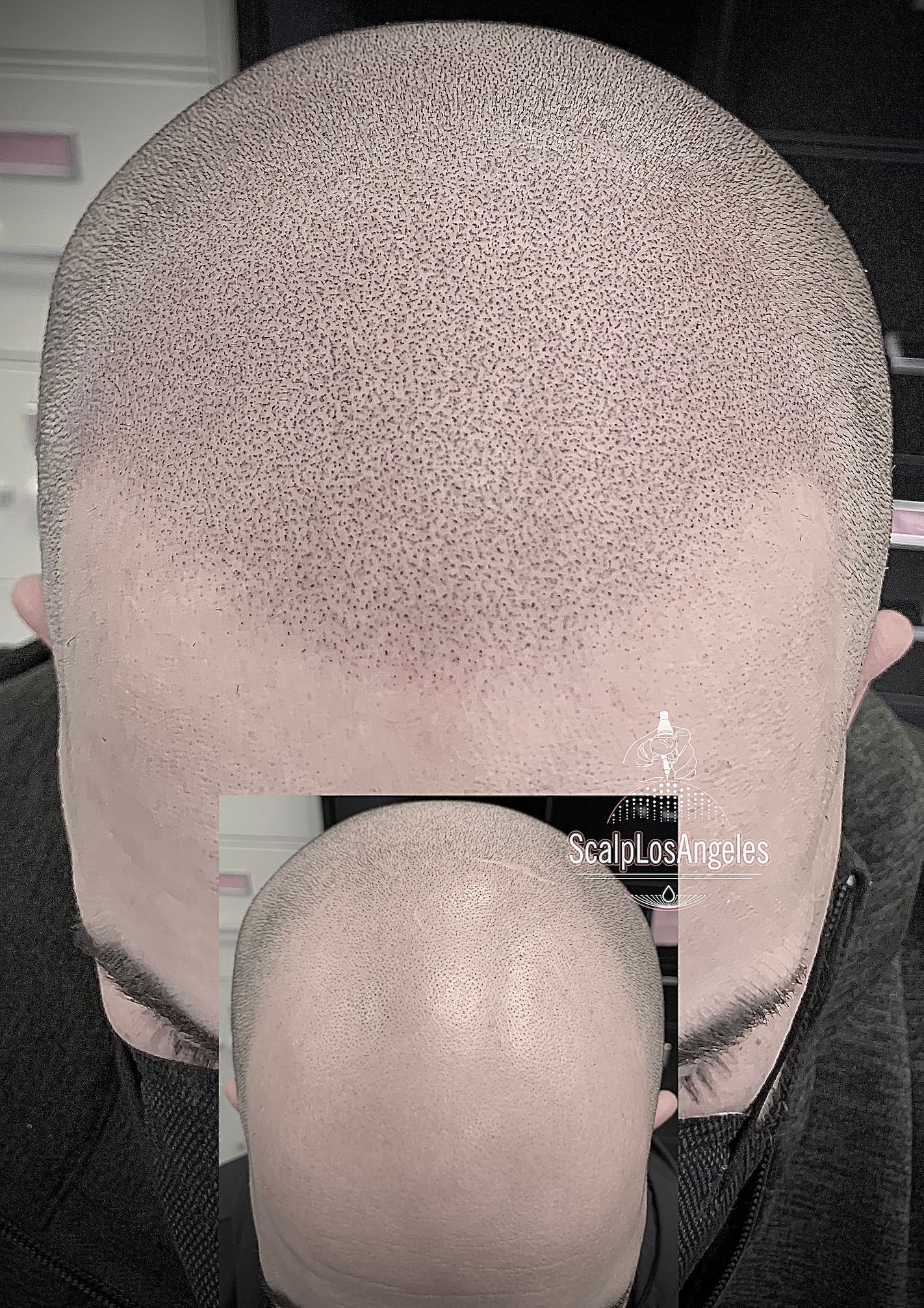 Male Pattern Baldness SMP Solution Before And After