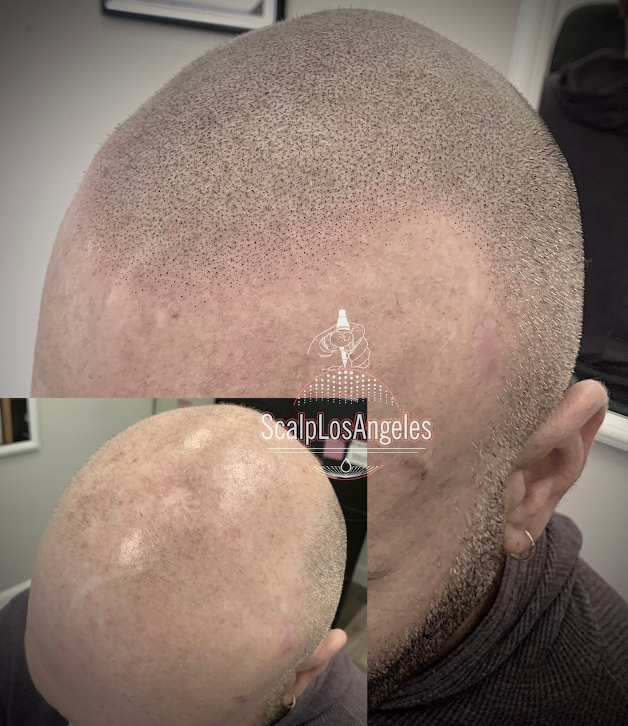 Hairline Soft Hyper Realistic Restoration