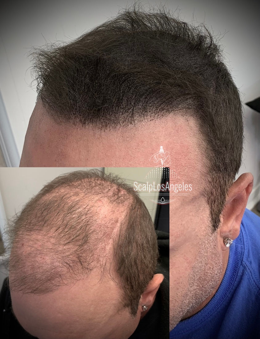 Best Hair Transplant Alternative