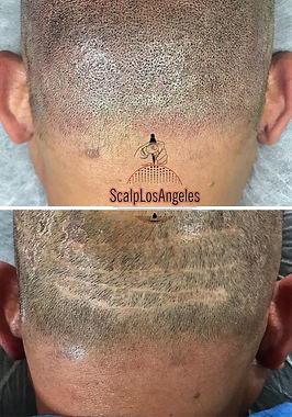 Hair Transplant FUT Scar SMP Cover Up