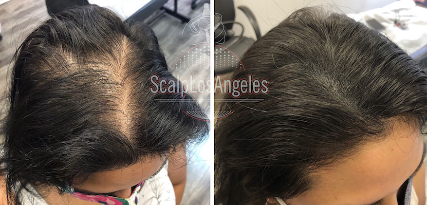 Female Hair Loss Treatment
