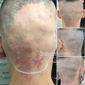 Alopecia Camouflage SMP Before And After Picture