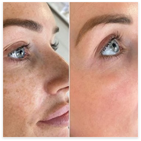 Beauty Full La Louvière microneedling COSMELAN BY MESOESTETIC