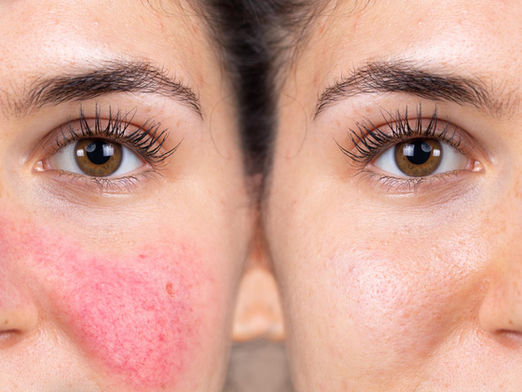 Rosacea: Why Facial Redness Happens & How It Can Be Managed