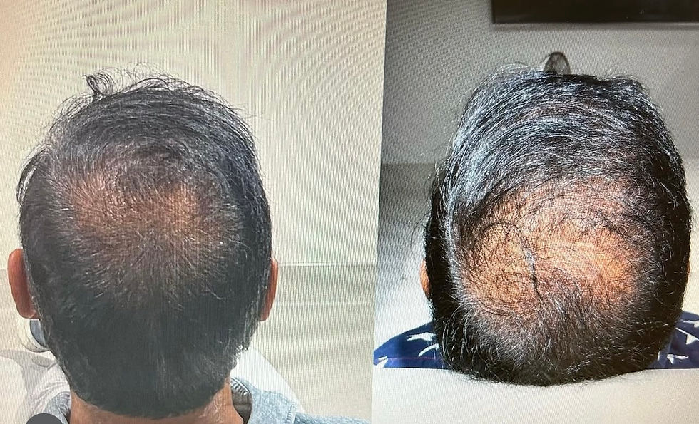 mans head before and after hair restoration 