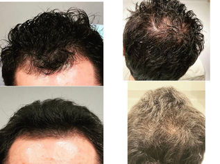 PRP vs Growth Factors for Hair Loss: What’s the Difference and What Works Best?