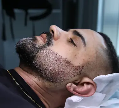 Beard-Transplant-Design-and-Planning-for-Facial-Harmony-2.webp