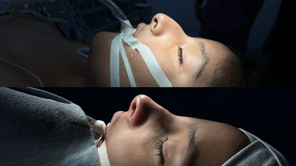 Rinoplastia.png