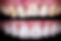 Veneers.jpg
