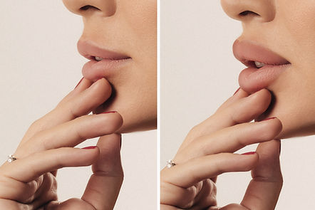 Woman's face side view close-up before and after Botox lip filler injections