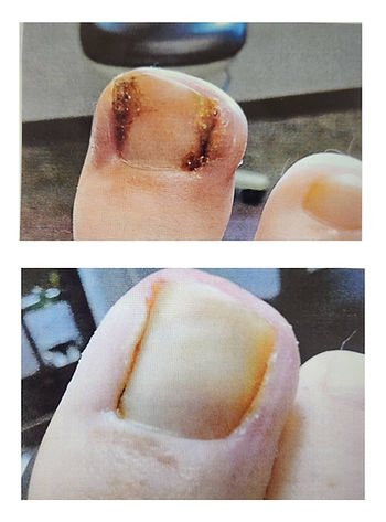 Before and after image of ingrown nail