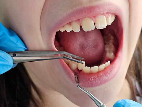 Dents d'enfants. Le médecin extrait une dent d'enfant