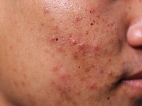 Acne Vulgaris
