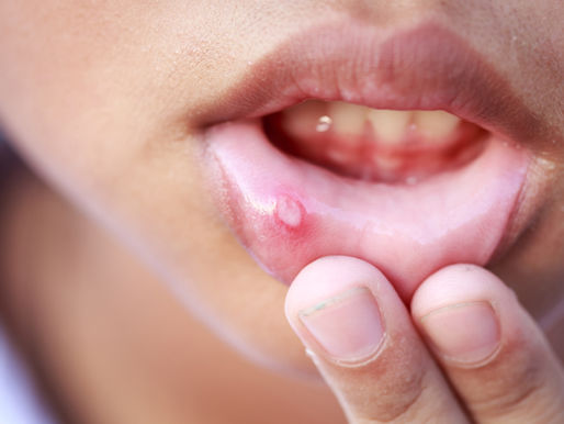Canker Sores: Signs, Symptoms, Causes, and Treatments