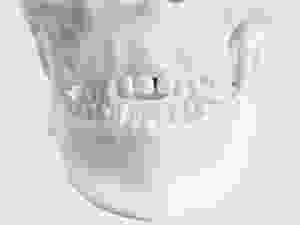 Tongue Thrusting Problem