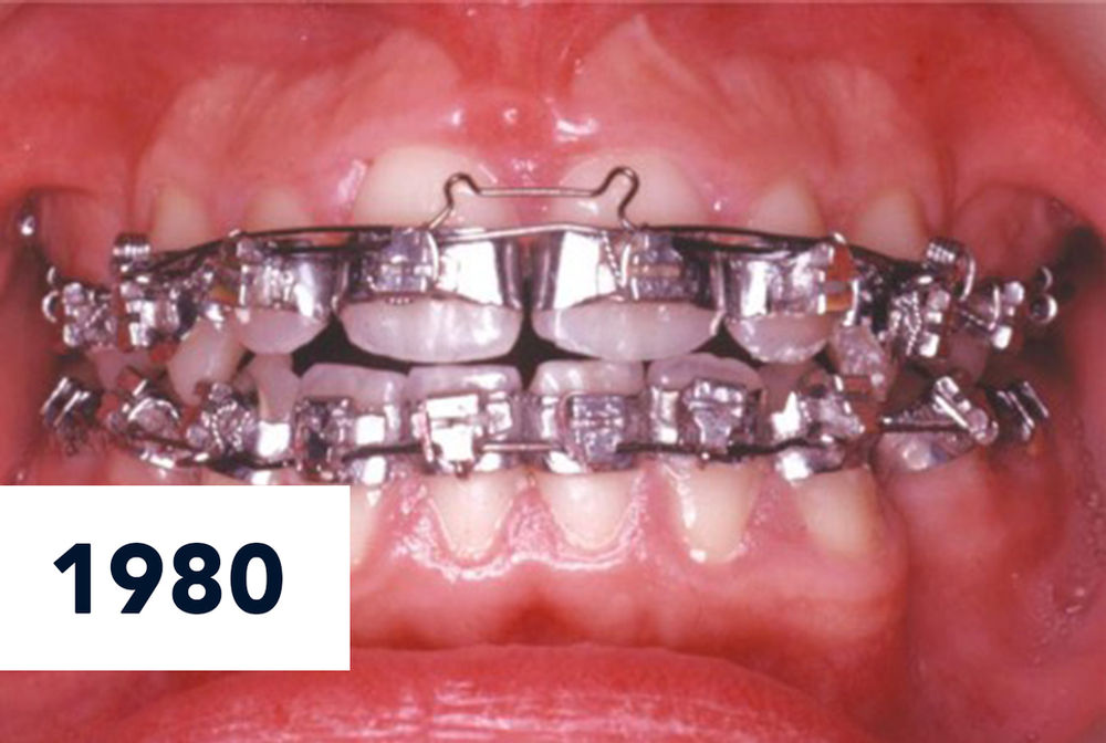 Some Things Never Change in Orthodontics… Unless It’s for the Better
