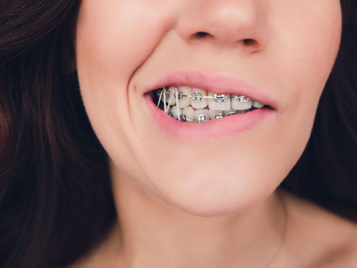Answers to Common Questions About Orthodontics (Part 2) – All About the Rubber Bands