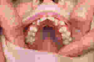 Narrow Palate