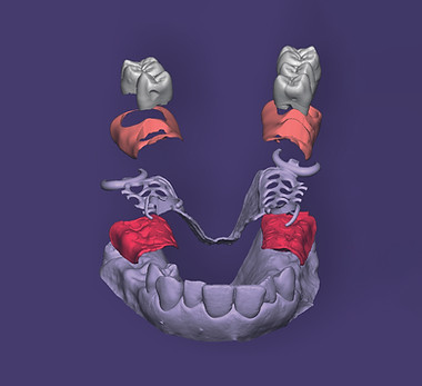 exocad_Quicksnap_Gingiva.jpg