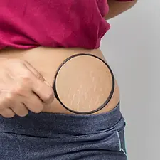 stretch-marks-treatment-medica-riyadh.jpg.webp