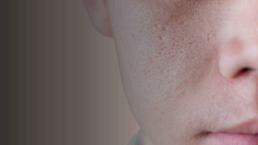 Large Pores.png