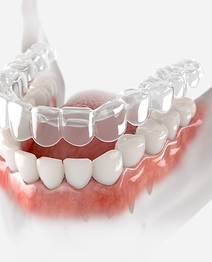 Aligner dentist