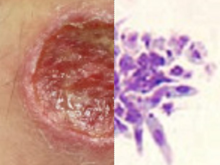 Leishmaniasis: No Longer Just An Unexpected Souvenir