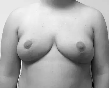 patient's breasts before breast reduction in Charlotte