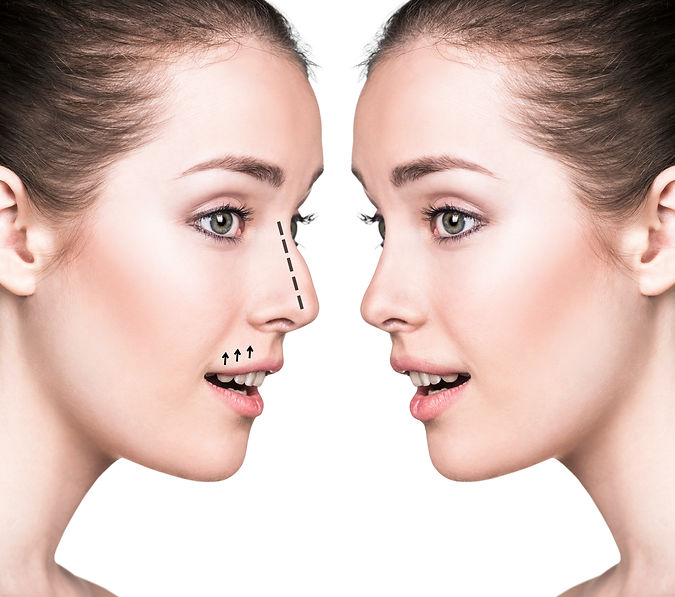Non-surgical nose job
