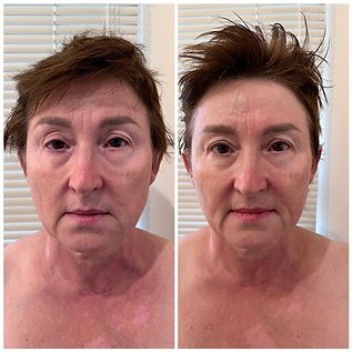 before and afterimages of sculptural face lifting massage in orlando florida