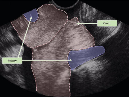 O que é Pessário Cervical?