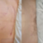 c-section before and after scar 2.jpg