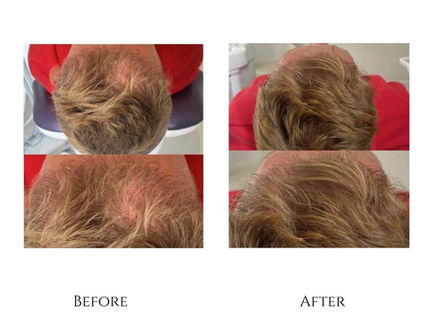 Before and after comparison of hair growth, shows the effect on the scalp.