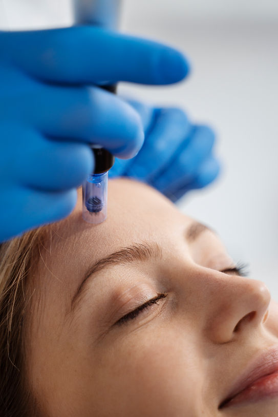 Microneedling treatment on woman's forehead by a professional, close up view.