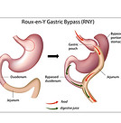 bypass gastrico obesità