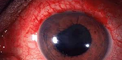 uveitis.jpg