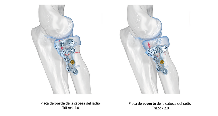 placas de cabeza de radio 2.png