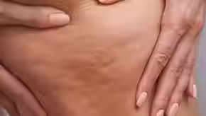 Lipocavitation Candiac