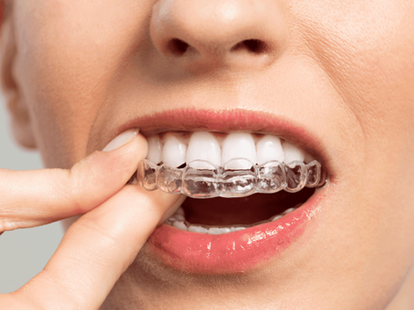 Invisalign Braces Treatment Journey: Step-by-Step Guide