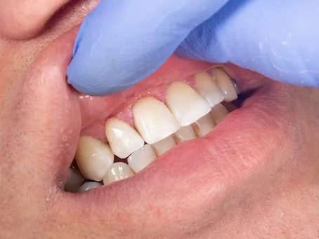 Dental Crown and Bridges When to Consider These Restorative Options