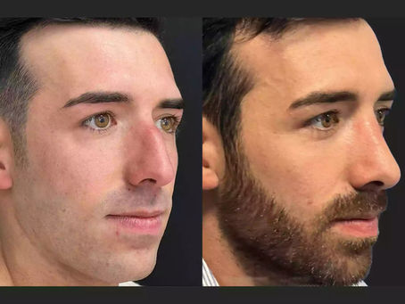 Rhinoplasty for a Hooked Nose: Is It a Quick Fix?