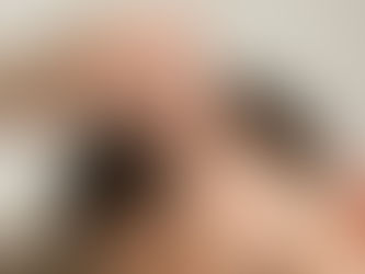 Hair Transplant Scars: What They Look Like and How to Hide