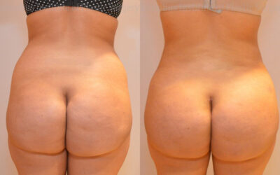 Why Patients Choose Our Clinic for Buttock Augmentation Surgery in Dubai