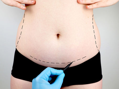 Will a Tummy Tuck Make You Look Instantly Slimmer?